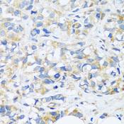 C3orf10 Antibody - Immunohistochemistry of paraffin-embedded Human breast cancer using BRK1 Polyclonal Antibody at dilution of 1:100 (40x lens).