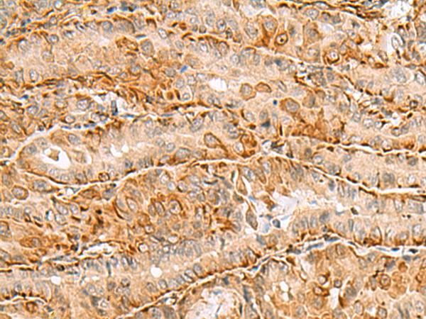 C3orf38 Antibody - Immunohistochemistry of paraffin-embedded Human thyroid cancer tissue  using C3orf38 Polyclonal Antibody at dilution of 1:80(×200)