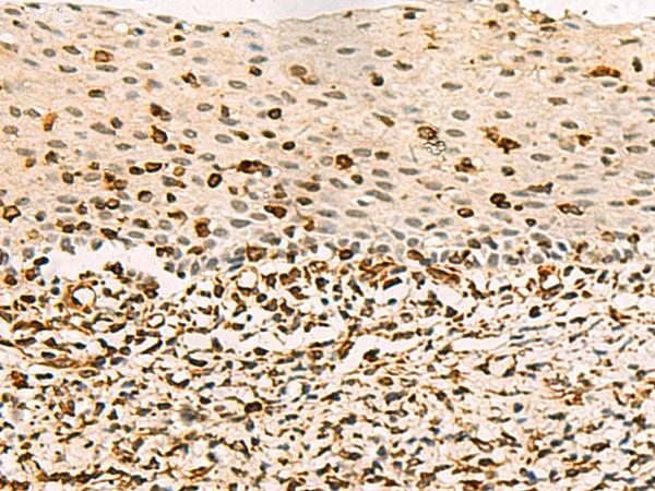 C3orf38 Antibody - Immunohistochemistry of paraffin-embedded Human cervical cancer tissue  using C3orf38 Polyclonal Antibody at dilution of 1:80(×200)