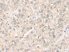 C3orf38 Antibody - Immunohistochemistry of paraffin-embedded Human liver cancer tissue  using C3orf38 Polyclonal Antibody at dilution of 1:95(×200)