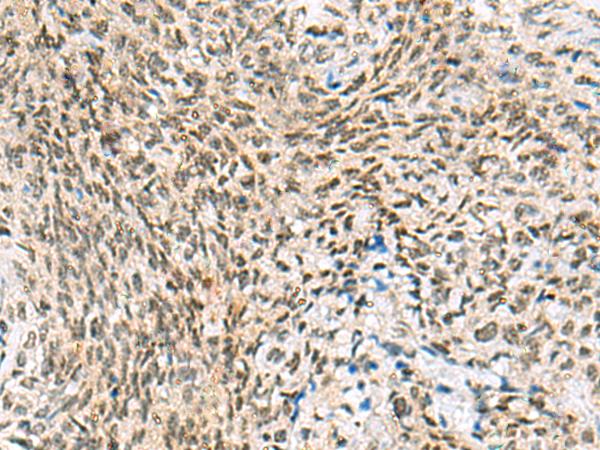 C3orf38 Antibody - Immunohistochemistry of paraffin-embedded Human cervical cancer tissue  using C3orf38 Polyclonal Antibody at dilution of 1:95(×200)