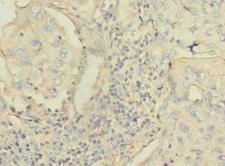 C4BPA / C4BP Alpha Antibody - Immunohistochemistry of paraffin-embedded human lung cancer using C4BPA Antibody at dilution of 1:100