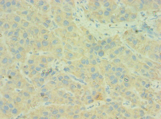 C4BPB / C4BP Beta Antibody - Immunohistochemistry of paraffin-embedded human liver cancer using antibody at 1:100 dilution.