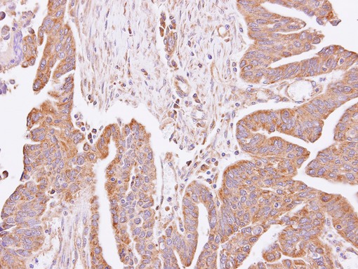 C4orf19 Antibody - IHC of paraffin-embedded Lung adenocarcinoma using C4orf19 antibody at 1:100 dilution.