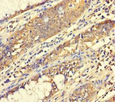 C4orf29 Antibody - Immunohistochemistry of paraffin-embedded human colon cancer using ABHD18 Antibody at dilution of 1:100