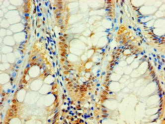 C4orf3 Antibody - Immunohistochemistry of paraffin-embedded human colon cancer using C4orf3 Antibody at dilution of 1:100