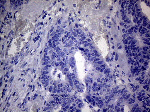 C4orf36 Antibody - Immunohistochemical staining of paraffin-embedded Adenocarcinoma of Human colon tissue using anti-C4orf36 mouse monoclonal antibody. This figure shows negative staining. (Heat-induced epitope retrieval by 1mM EDTA in 10mM Tris buffer. (pH8.5) at 120°C for 3 min. (1:150)