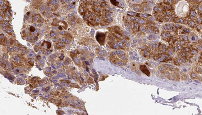 C5AR2 / GPR77 / C5L2 Antibody - 1:100 staining human liver carcinoma tissues by IHC-P. The sample was formaldehyde fixed and a heat mediated antigen retrieval step in citrate buffer was performed. The sample was then blocked and incubated with the antibody for 1.5 hours at 22°C. An HRP conjugated goat anti-rabbit antibody was used as the secondary.