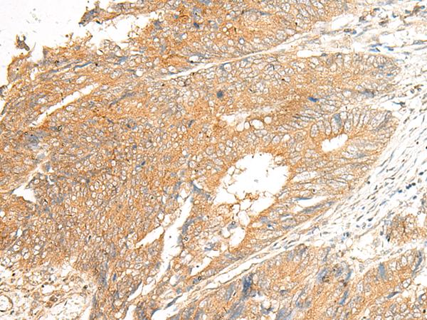 C5AR2 / GPR77 / C5L2 Antibody - Immunohistochemistry of paraffin-embedded Human colorectal cancer tissue  using C5AR2 Polyclonal Antibody at dilution of 1:25(×200)