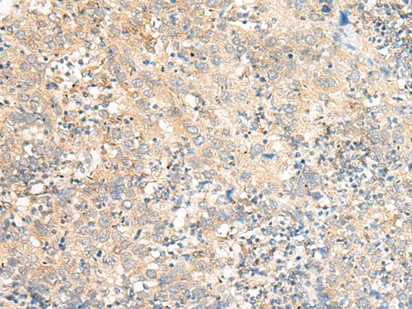 C5AR2 / GPR77 / C5L2 Antibody - Immunohistochemistry of paraffin-embedded Human cervical cancer tissue  using C5AR2 Polyclonal Antibody at dilution of 1:25(×200)