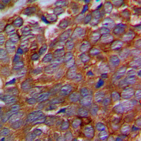 C5orf13 Antibody - Immunohistochemical analysis of p311 staining in human prostate cancer formalin fixed paraffin embedded tissue section. The section was pre-treated using heat mediated antigen retrieval with sodium citrate buffer (pH 6.0). The section was then incubated with the antibody at room temperature and detected using an HRP conjugated compact polymer system. DAB was used as the chromogen. The section was then counterstained with hematoxylin and mounted with DPX.