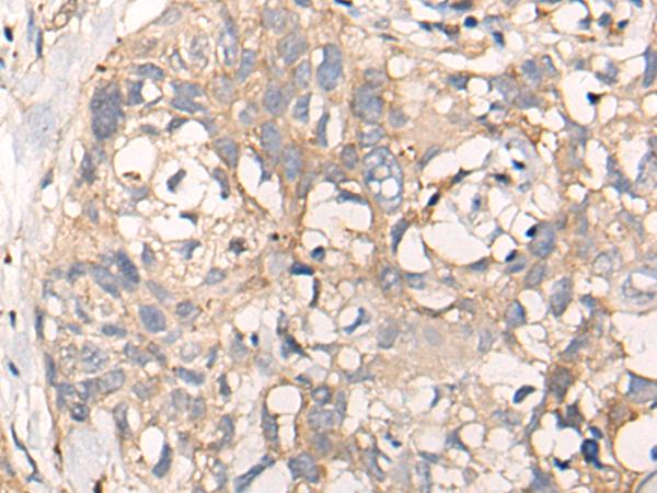 C5orf13 Antibody - Immunohistochemistry of paraffin-embedded Human lung cancer tissue  using NREP Polyclonal Antibody at dilution of 1:35(×200)