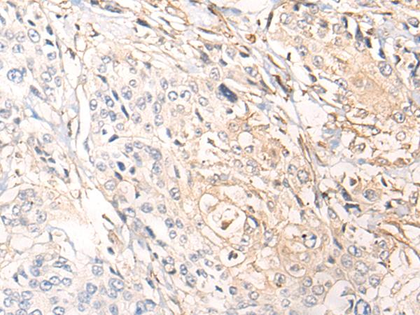C5orf13 Antibody - Immunohistochemistry of paraffin-embedded Human prost ate cancer tissue  using NREP Polyclonal Antibody at dilution of 1:35(×200)