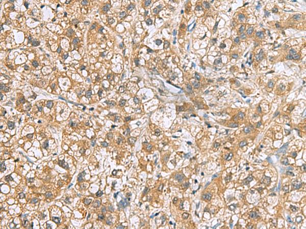 C6orf108 Antibody - Immunohistochemistry of paraffin-embedded Human liver cancer tissue  using DNPH1 Polyclonal Antibody at dilution of 1:60(×200)