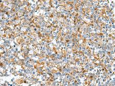 C6orf108 Antibody - Immunohistochemistry of paraffin-embedded Human tonsil tissue  using DNPH1 Polyclonal Antibody at dilution of 1:55(×200)