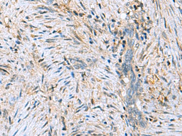 C6orf108 Antibody - Immunohistochemistry of paraffin-embedded Human cervical cancer tissue  using DNPH1 Polyclonal Antibody at dilution of 1:55(×200)