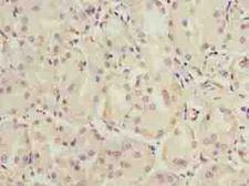 C6orf141 Antibody - Immunohistochemistry of paraffin-embedded human gastric cancer using antibody at dilution of 1:100.