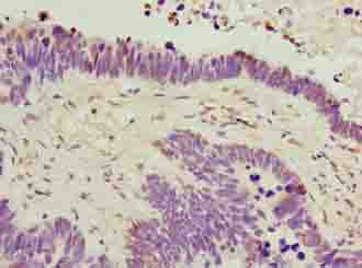 C6orf141 Antibody - Immunohistochemistry of paraffin-embedded human ovarian cancer using antibody at dilution of 1:100.