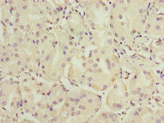 C6orf141 Antibody - Immunohistochemistry of paraffin-embedded human gastric cancer using C6orf141 Antibody at dilution of 1:100