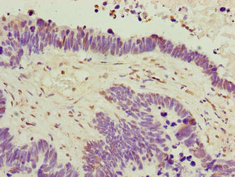 C6orf141 Antibody - Immunohistochemistry of paraffin-embedded human ovarian cancer using C6orf141 Antibody at dilution of 1:100