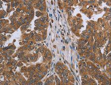 C6orf66 Antibody - Immunohistochemistry of paraffin-embedded Human ovarian cancer using NDUFAF4 Polyclonal Antibody at dilution of 1:45.