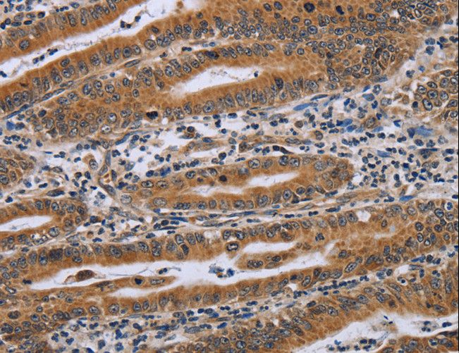 C6orf66 Antibody - Immunohistochemistry of paraffin-embedded Human gastric cancer using NDUFAF4 Polyclonal Antibody at dilution of 1:45.