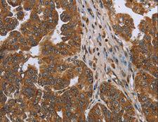 C6orf66 Antibody - Immunohistochemistry of paraffin-embedded Human ovarian cancer using NDUFAF4 Polyclonal Antibody at dilution of 1:50.