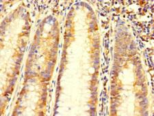 C6orf89 Antibody - Immunohistochemistry of paraffin-embedded human colon cancer using C6orf89 Antibody at dilution of 1:100