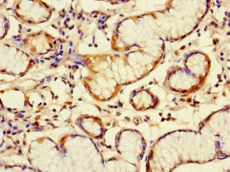C6orf89 Antibody - Immunohistochemistry of paraffin-embedded human gastric cancer using C6orf89 Antibody at dilution of 1:100