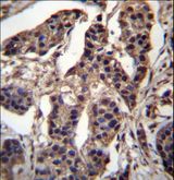 C7orf25 Antibody - CG025 Antibody immunohistochemistry of formalin-fixed and paraffin-embedded human bladder carcinoma followed by peroxidase-conjugated secondary antibody and DAB staining.