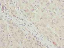 C7orf34 Antibody - Immunohistochemistry of paraffin-embedded human liver cancer using antibody at dilution of 1:100.