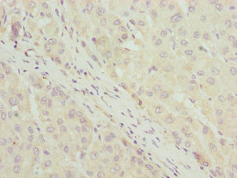 C7orf34 Antibody - Immunohistochemistry of paraffin-embedded human liver cancer using C7orf34 Antibody at dilution of 1:100