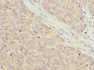C8orf22 Antibody - Immunohistochemistry of paraffin-embedded human ovarian cancer using antibody at dilution of 1:100.