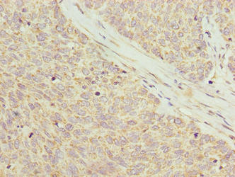 C8orf22 Antibody - Immunohistochemistry of paraffin-embedded human ovarian cancer using C8orf22 Antibody at dilution of 1:100