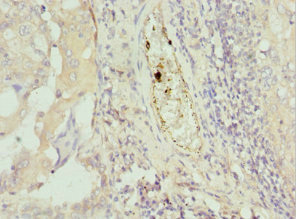 C8orf4 Antibody - Immunohistochemistry of paraffin-embedded human lung cancer tissue at dilution 1:100