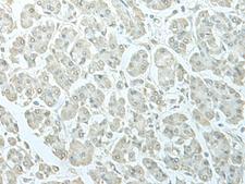 C8orf4 Antibody - Immunohistochemistry of paraffin-embedded Human gastric cancer tissue  using C8orf4 Polyclonal Antibody at dilution of 1:55(×200)
