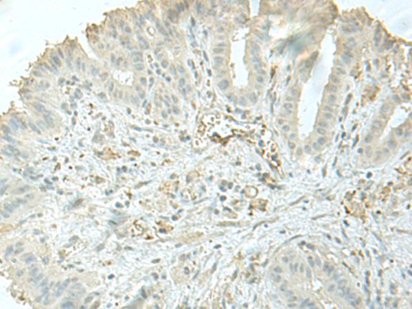 C8orf4 Antibody - Immunohistochemistry of paraffin-embedded Human thyroid cancer tissue  using C8orf4 Polyclonal Antibody at dilution of 1:55(×200)