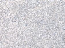 C8orf4 Antibody - Immunohistochemistry of paraffin-embedded Human ovarian cancer tissue  using C8orf4 Polyclonal Antibody at dilution of 1:70(×200)
