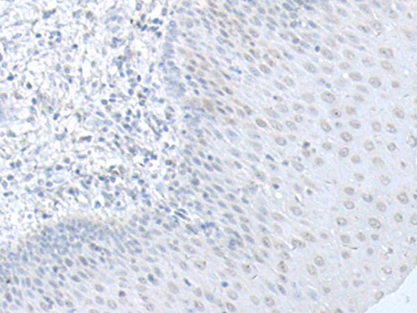 C8orf4 Antibody - Immunohistochemistry of paraffin-embedded Human esophagus cancer tissue  using C8orf4 Polyclonal Antibody at dilution of 1:70(×200)