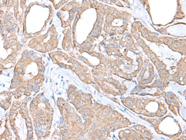 C9orf116 Antibody - Immunohistochemistry of paraffin-embedded Human thyroid cancer tissue  using C9orf116 Polyclonal Antibody at dilution of 1:55(×200)