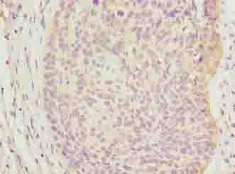 C9orf43 Antibody - Immunohistochemistry of paraffin-embedded human cervical cancer using antibody at dilution of 1:100.