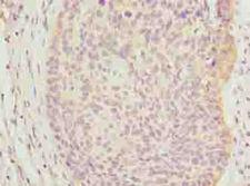 C9orf43 Antibody - Immunohistochemistry of paraffin-embedded human cervical cancer using antibody at dilution of 1:100.