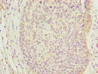 C9orf43 Antibody - Immunohistochemistry of paraffin-embedded human cervical cancer using C9orf43 Antibody at dilution of 1:100