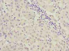 C9orf64 Antibody - Immunohistochemistry of paraffin-embedded human liver cancer using antibody at dilution of 1:100.