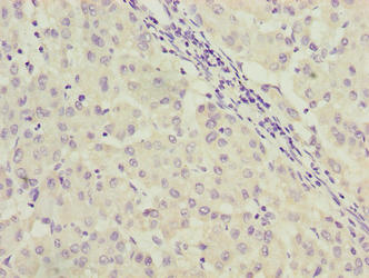 C9orf64 Antibody - Immunohistochemistry of paraffin-embedded human liver cancer using C9orf64 Antibody at dilution of 1:100