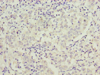 C9orf64 Antibody - Immunohistochemistry of paraffin-embedded human lung cancer using C9orf64 Antibody at dilution of 1:100