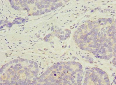C9orf89 Antibody - Immunohistochemistry of paraffin-embedded human gastric cancer using antibody at dilution of 1:100.