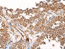 CA-VB / CA5B Antibody - Immunohistochemistry of paraffin-embedded Human ovarian cancer tissue  using CA5B Polyclonal Antibody at dilution of 1:65(×200)