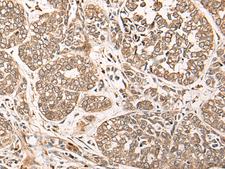 CA-VB / CA5B Antibody - Immunohistochemistry of paraffin-embedded Human esophagus cancer tissue  using CA5B Polyclonal Antibody at dilution of 1:85(×200)