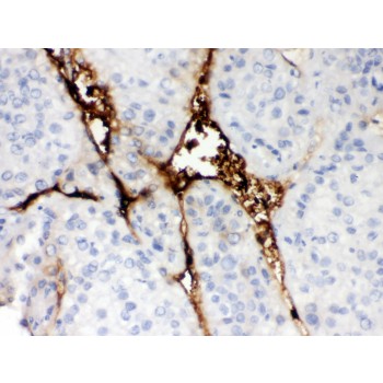 CA1 / Carbonic Anhydrase I Antibody - CA1 antibody IHC-paraffin. IHC(P): Human Liver Cancer Tissue.